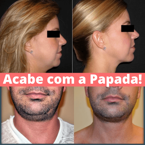 Removedor de Papada e Antirrugas - FaceSkin™ - [Lançamento] - Genial Presentes